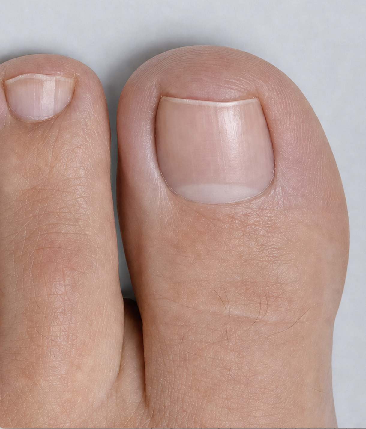 Clearer nail after Nailtroe treatment