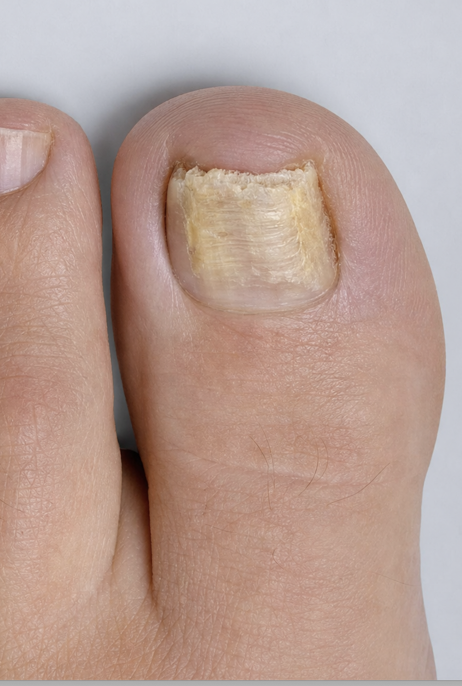 Fungal nail before Nailtroe treatment